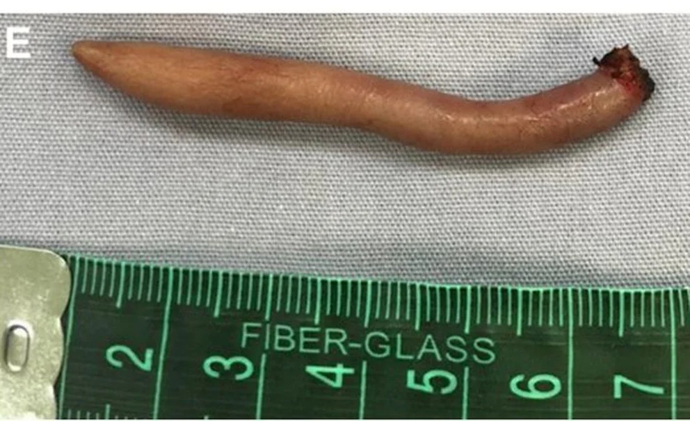 Fotografía clínica, una cola humana en la región sacrococcígea, justo encima de la hendidura glútea y ligeramente a la izquierda de la línea media (Foto: Journal of Pediatric Surgery Case Reports)
