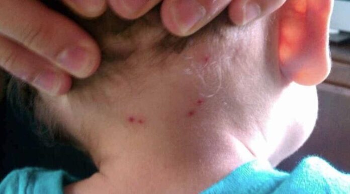 Muere por rickettsia