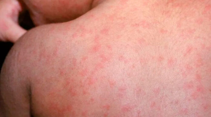 Salud reporta 859 casos de sarampión en México; llama a verificar vigilancia y diagnóstico