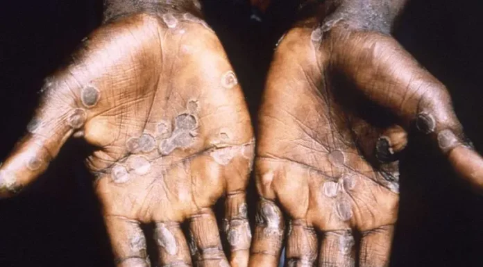 Aumentan exponencialmente los casos de viruela del mono en el Congo