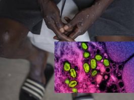 La OMS advierte probabilidad de nuevos brotes de mpox en Europa, tras detección de caso en Suecia