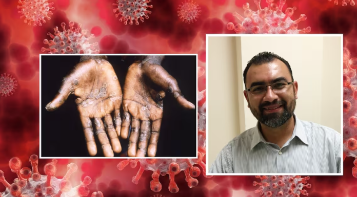 Casos de Mpox detectados en Sonora no deben ser motivo de preocupación: Médico