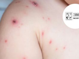 Pacientes con Mpox serían dados de alta en la segunda semana de septiembre