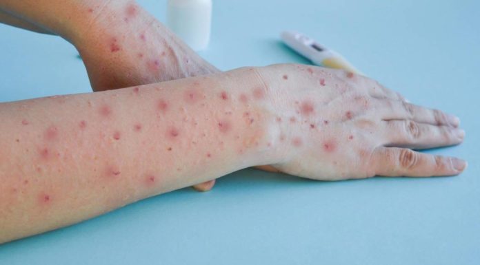 Confirman dos casos importados de Mpox o ‘viruela del mono’ en Sonora