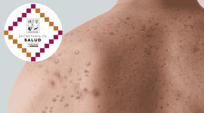 Detectan nuevo caso sospechoso de ‘viruela del mono’ en Sonora