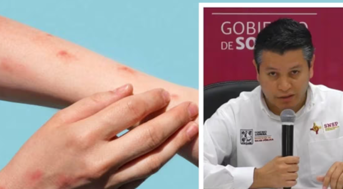 Salud Sonora vigila contactos de Mpox en Hermosillo y SLRC