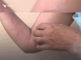 Confirman el primer caso de sarampión en Nogales, Sonora