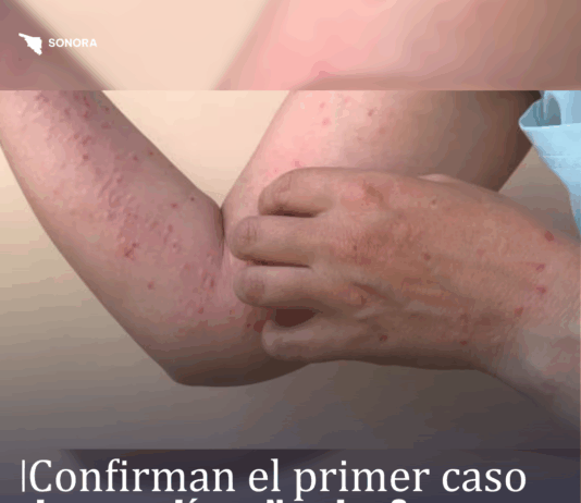 Confirman el primer caso de sarampión en Nogales, Sonora