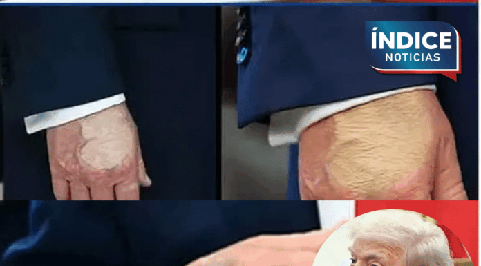 Trump muestra las mismas lesiones que la reina Isabel antes de morir